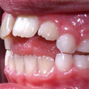 malocclusion malocclusion